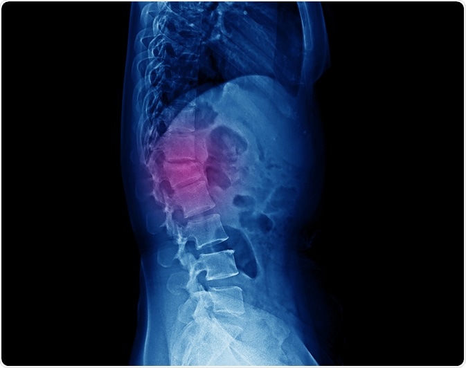Lateral projection lumbar spine x-ray showing compression fracture at L1 vertebra with mild degree height loss. Image Credit: Yok_onepiece / Shutterstock