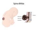 Spina Bifida Pathophysiology