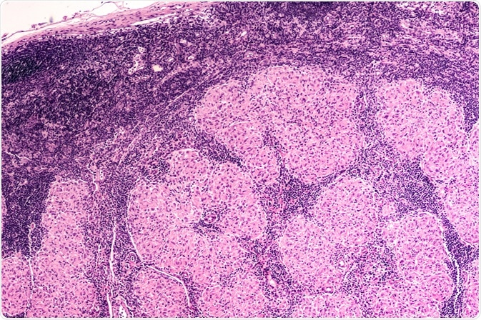 Micrograph of an enlarged lymph node showing non-caseating granulomas of sarcoidosis. Image Credit: David A Litman / Shutterstock