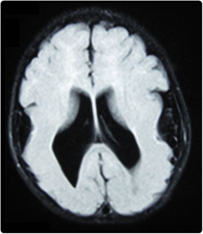 Cerveau IRM, T1 pesé, avion transverse, qui expositions lyssencephaly, manifesté en tant que circonvolutions rares et larges, en grande partie dans l
