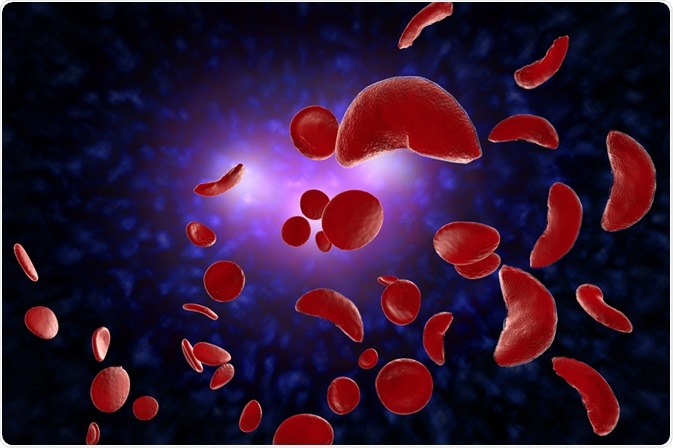 Sickle cell anemia disease (SCD) blood cells 3D illustration. Image Credit: Ezume Images / Shutterstock