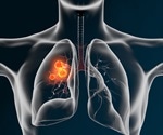 Lung Cancer: Radiotherapy and Chemotherapy