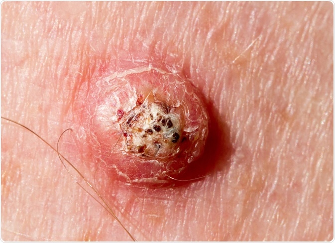 Keratoacanthoma on the leg of a 64-year-old male at six weeks development stage. Image Credit: Peter Mullineux