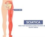 Sciatica Treatments