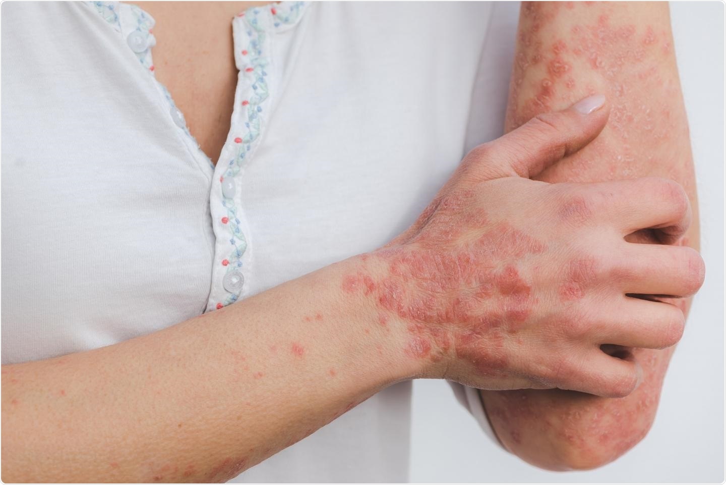 Study explains the link between psoriasis treatment and cardiovascular diseases
