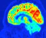 UVA's imaging approach could help identify brain surgery targets to stop epilepsy seizures