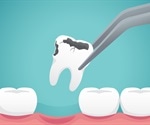 Tooth Extraction Risks