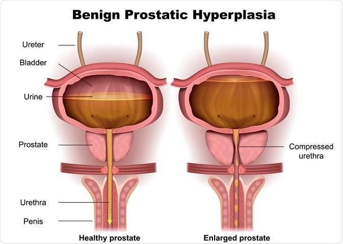 Solved Benign prostatic hypertrophy (BPH) is a fairly common