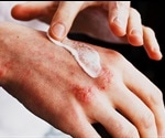 Eczema Triggers