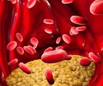 What is Hypertriglyceridemia?