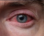 Blepharitis Diagnosis and Treatment