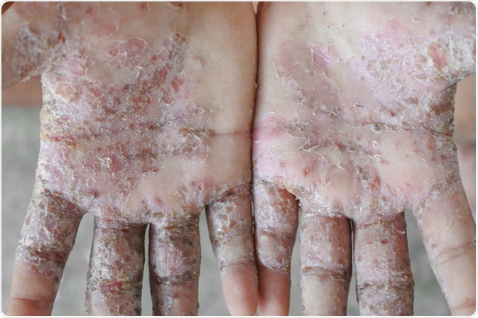 Scabies Pictures Of