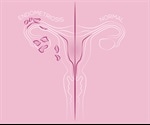 Missed or Delayed Diagnosis of Endometriosis