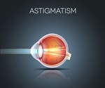 Astigmatism Types - Regular and Irregular