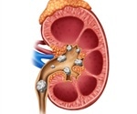 Kidney Stones - Nephrolithiasis