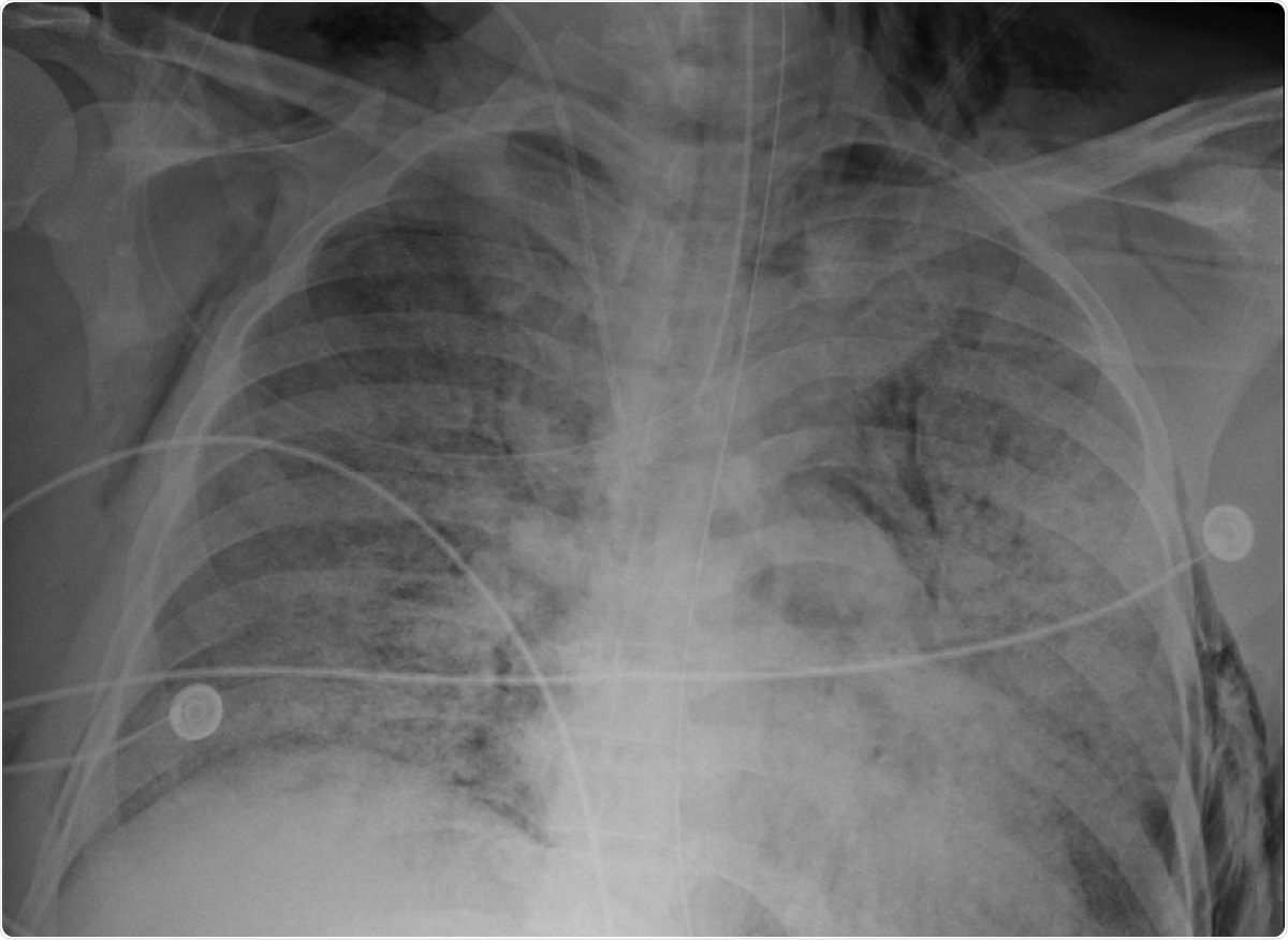 Chest radiograph showing right-sided subcutaneous emphysema and right-sided apical pneumothorax. Image Credit: original article / Cureus