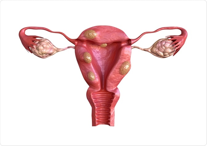 fibroids uterini