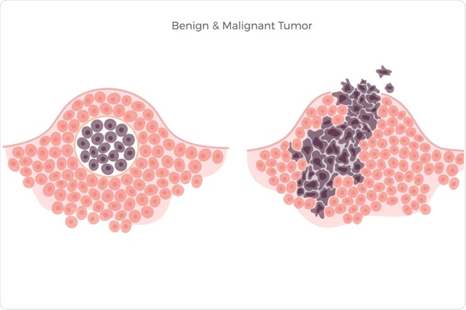 Benign cancer types. Benign cancer growth, Papiloma virus pozitiv