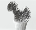 Types of Osteogenesis Imperfecta (OI) / Brittle Bone Disease
