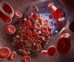 Preventing lethal blood clots