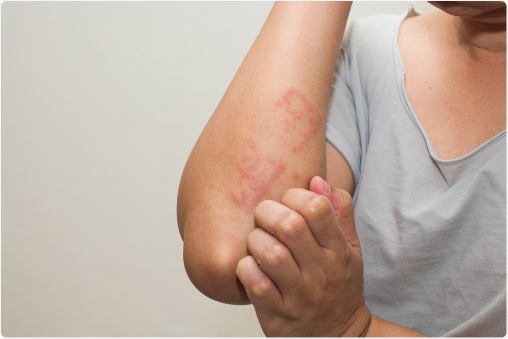 What Causes a Rash on the Breast?