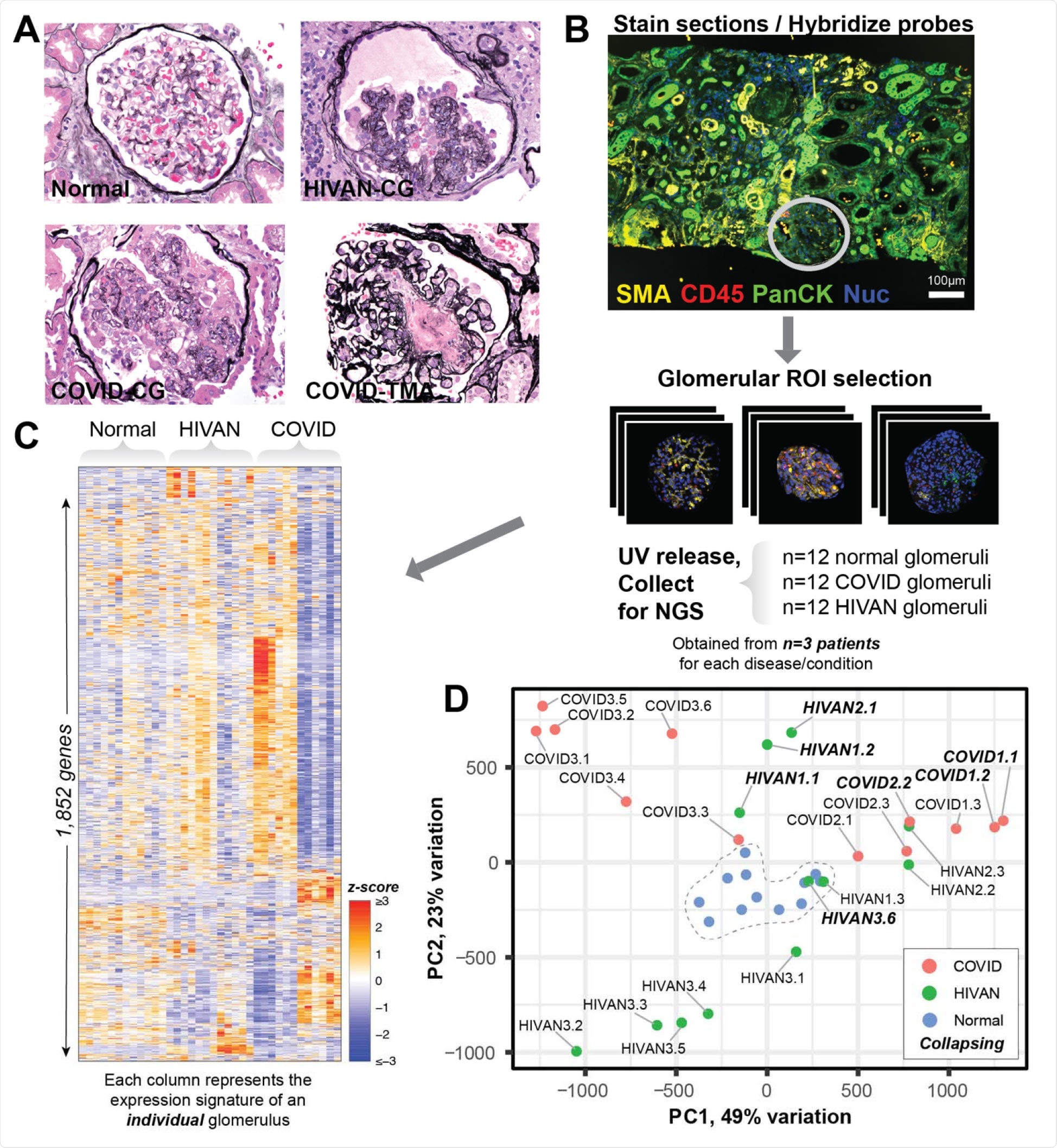 Digital spatial profiling of individual glomeruli from HIV and COVID-19 patients. A) Representative Jones-stained sections of glomeruli with histology analyzed by digital spatial profiling. HIVAN – HIV associated nephropathy; CG – collapsing glomerulopathy; COVID – SARS-CoV-2 associated disease; TMA – thrombotic microangiopathy. B) Biopsy sections were immunostained with fluorescent antibodies against the indicated markers and free from regions of interest (ROI) were drawn around glomeruli of interest. Bound probes were released and quantified by next generation sequencing. C) 1852 genes (rows) were quantified from each glomerulus (columns) from