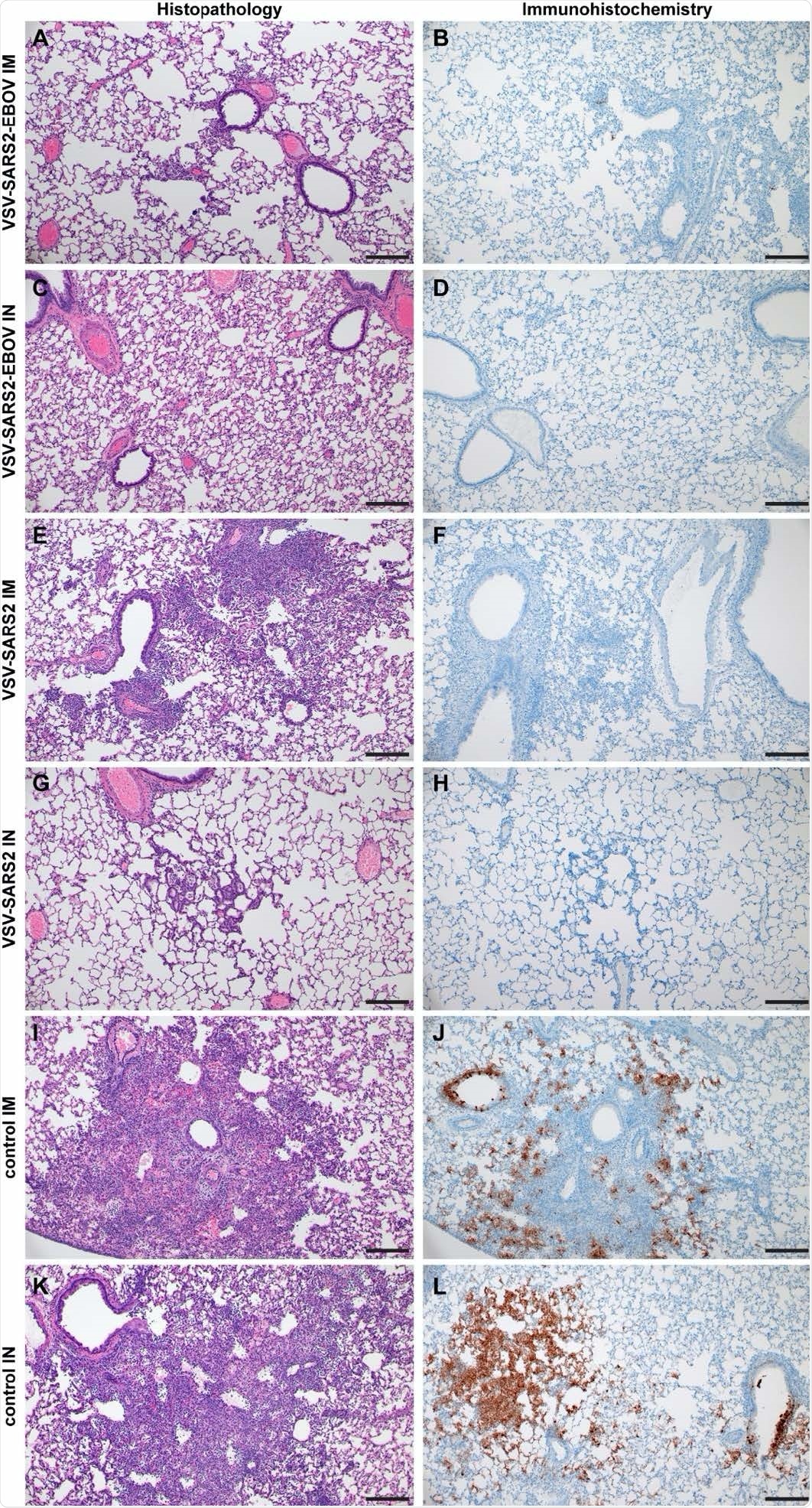Histopathology and Immunohistochemistry of h 612 amster lungs with challenge 10 DPV. Hamsters were vaccinated 10 days prior to challenge with SARS-CoV-2 WA1. At 4 days after challenge lung samples were collected and stained with H&E or anti-SARS-CoV-2 nucleocapsid (N) antibody for IHC. (A) Rare foci of minimal to mild interstitial pneumonia with mild alveolar spillover. (B) Rare type I pneumocyte immunoreactivity. (C) Lack of notable pulmonary histopathology. (D) No immunoreactivity to SARS-CoV-2 N. (E) Focus of mild to moderate broncho-interstitial pneumonia with perivascular leukocyte cuffing. (F) Limited type I pneumocyte immunoreactivity. (G) Rare foci of minimal to mild interstitial pneumonia with type II pneumocyte hyperplasia. (H) No immunoreactivity to SARS-CoV-2 N. (I) Focus of moderate to severe bronchointerstitial pneumonia with disruption of pulmonary architecture by degenerate and non-degenerate neutrophils, macrophages and cellular debris accompanied with perivascular and pulmonary edema. (J) Abundant immunoreactivity to SARS-CoV-2 N in columnar epithelium of bronchioles, type I pneumocytes and alveolar macrophages. (K) Moderate broncho-interstitial pneumonia with influx of moderate to numerous leukocytes and limited pulmonary edema. (L) Abundant immunoreactivity to SARS-CoV-2 N in bronchiolar epithelium, type I and II pneumocytes and within cellular debris. (200x, bar = 50 μM).