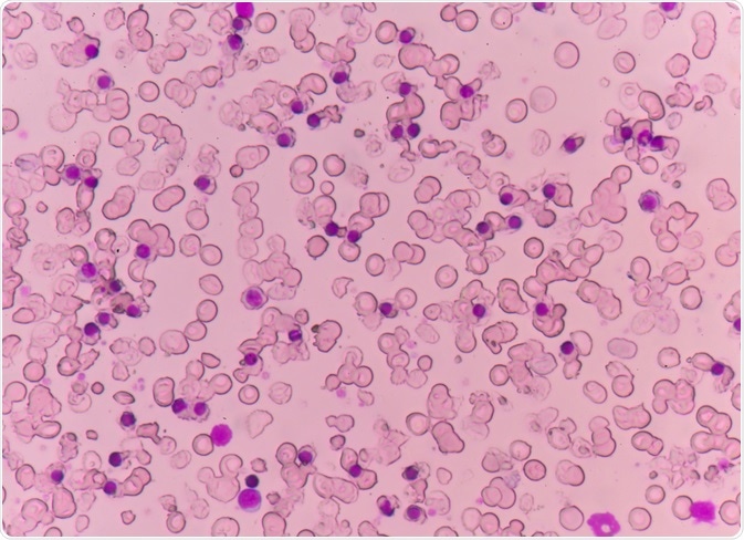 Red blood cells from thalassemia patient