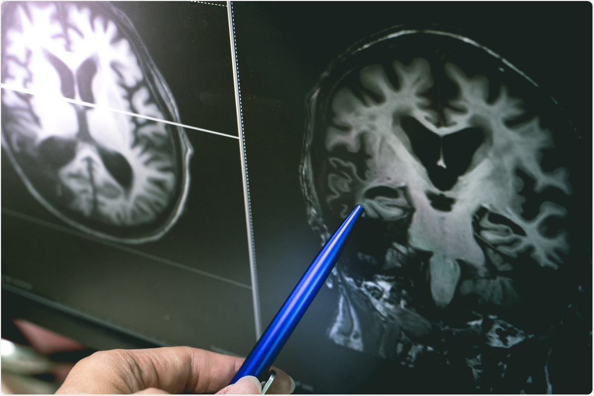 Study: Can SARS-CoV-2 Infection Exacerbate Alzheimer’s Disease? An Overview of Shared Risk Factors and Pathogenetic Mechanisms. Image Credit: Atthapon Raksthaput / Shutterstock.com