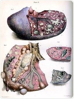 Gross pathology of lung tuberculosis.