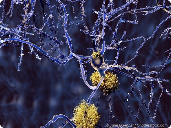 Amyloid Plaques on Neurons