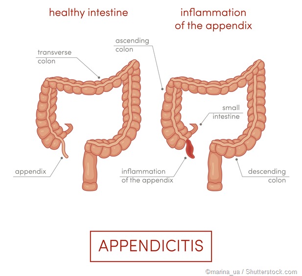 Appendix inflammation