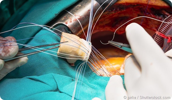 Artifitial heart valve implantation
