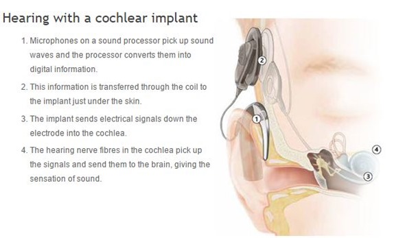 Cochlear implant hearing
