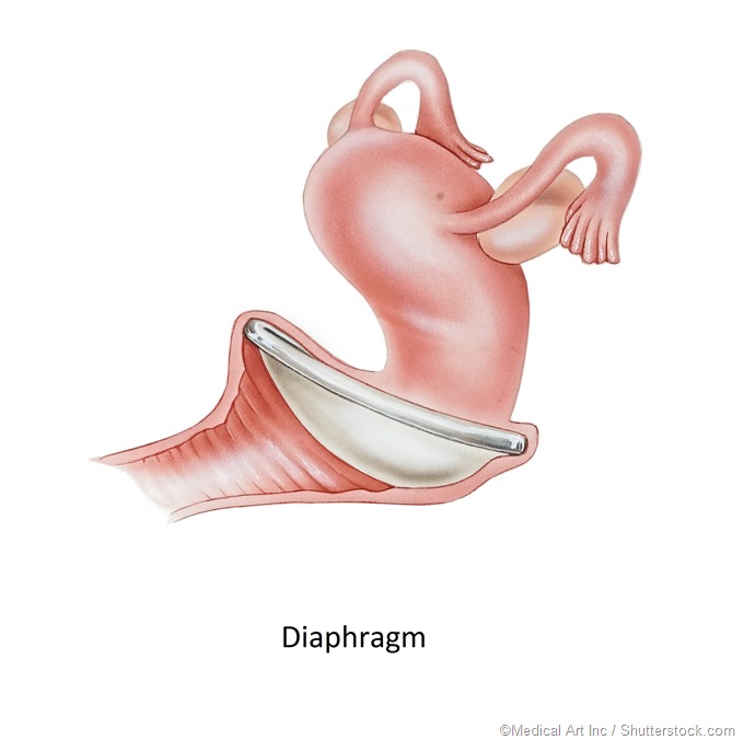 Contraception diaphragm