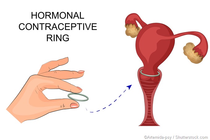 Contraception vaginal ring