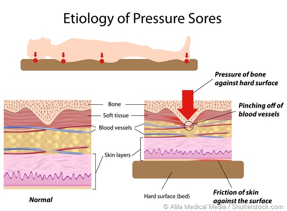 Etiology of pressure sores