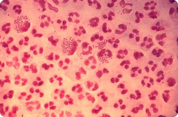 This photomicrograph reveals the histopathology in an acute case of gonococcal urethritis using Gram-stain technique.
