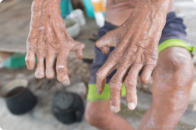 Hand injuries from leprosy