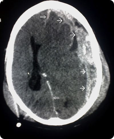 Head trauma CT scan