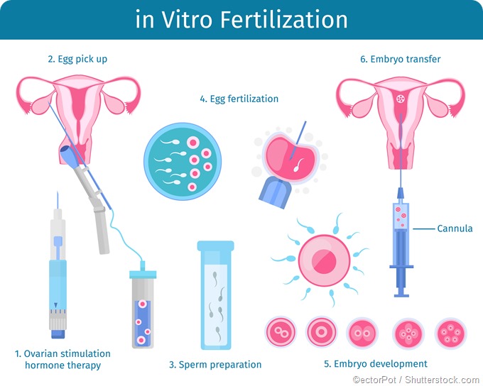 Infographic de proceso de IVF