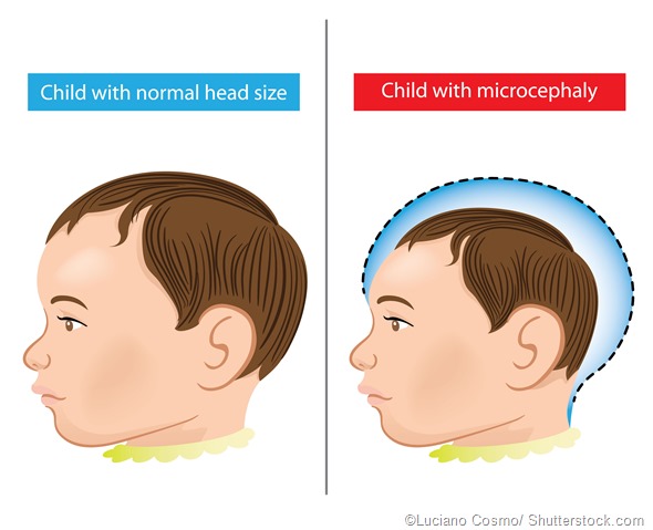 baby Microcephaly disease illustration