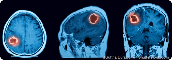 Hemorragia cerebral de la exploración de MRI