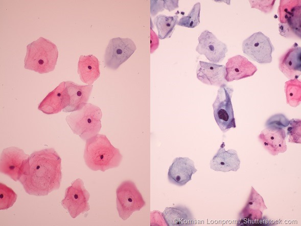 Normal and abnormal cells pap smear