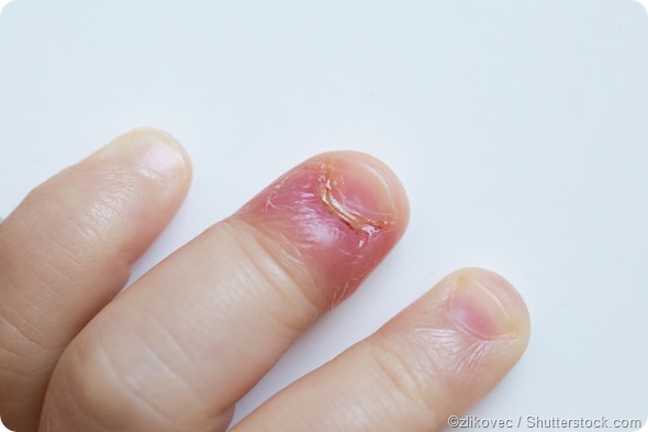 Paronychia on fingernail