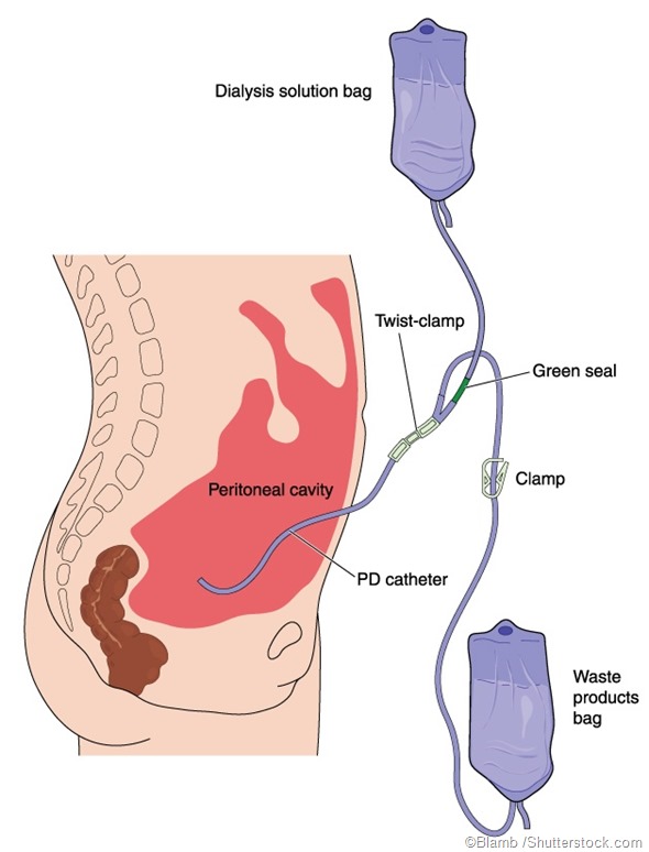 Peritoneal dialysis illustration