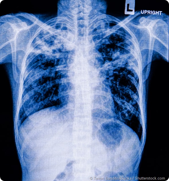 Pneumonia patients x-ray film