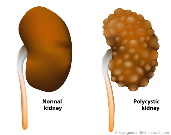Polycystic kidney disease. Normal and polycystic kidneys