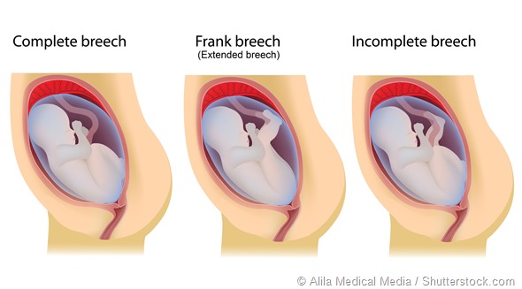 Pregnancy breech