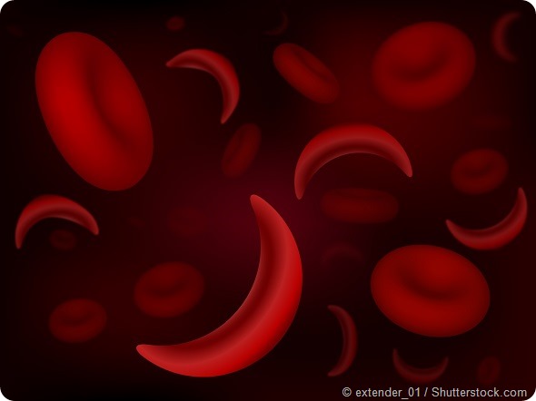 Red blood cells of sickle cell anaemia disease and normal cells
